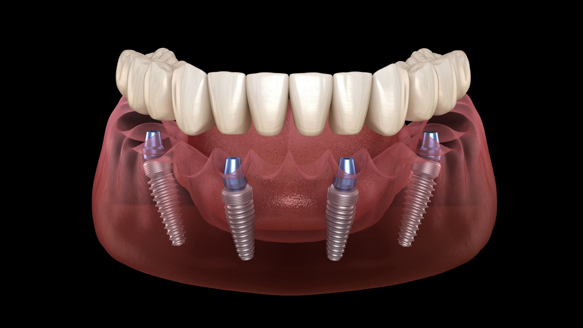 <trp-post-container data-trp-post-id='1002'>What are the stages of full jaw implantation?</trp-post-container>