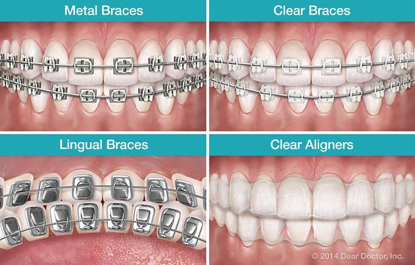 <trp-post-container data-trp-post-id='957'>The best types of braces</trp-post-container>