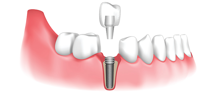 <trp-post-container data-trp-post-id='899'>Immediate Dental Implants</trp-post-container>