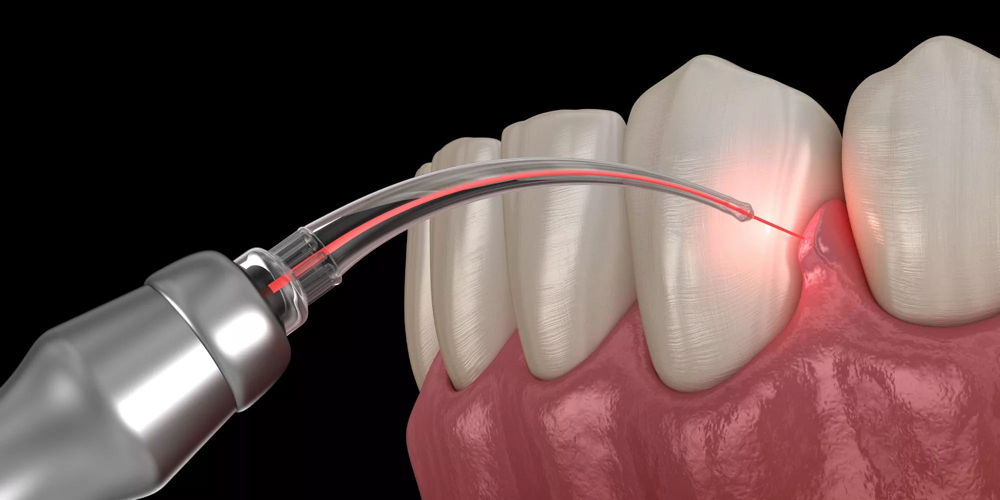 <trp-post-container data-trp-post-id='951'>Benefits of laser in dentistry</trp-post-container>