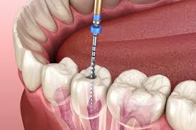 <trp-post-container data-trp-post-id='944'>Can a root canal be done in one session?</trp-post-container>