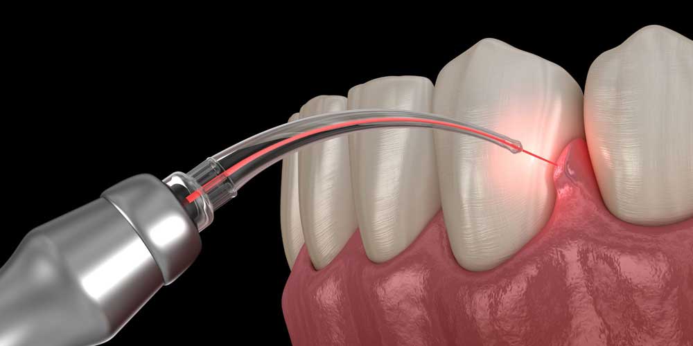 <trp-post-container data-trp-post-id='932'>Laser gum lightening for a bright and beautiful smile</trp-post-container>