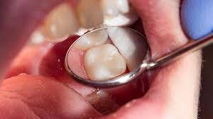 <trp-post-container data-trp-post-id='905'>Best Permanent Fillings</trp-post-container>