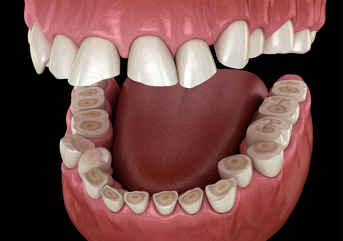 <trp-post-container data-trp-post-id='926'>Why Teeth Grinding</trp-post-container>