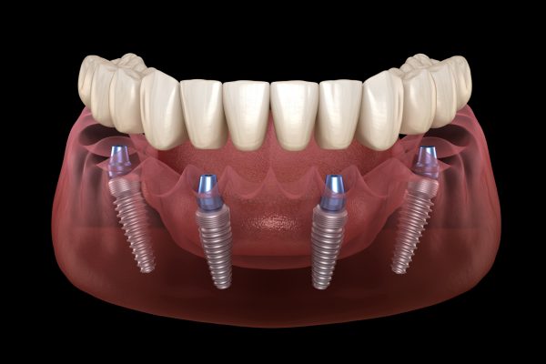 14-be-implant-pour-machoire-complete