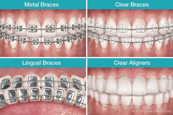Dental-braces-types