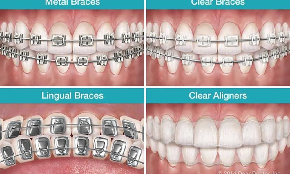 Dental-braces-types