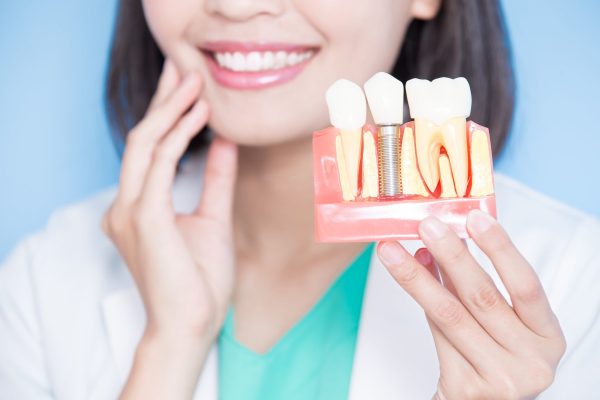 Dental_Implants