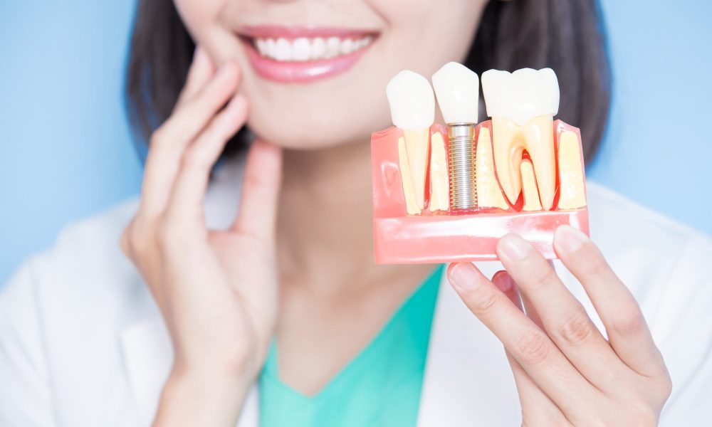 Dental_Implants