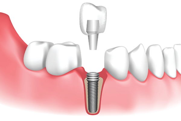dental-implant