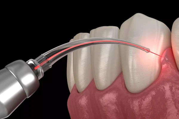 dental-laser-graphic-1-1