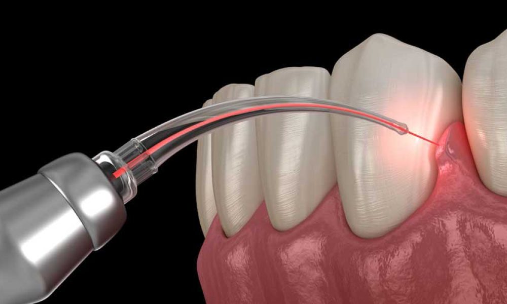 gum-disease-treatment-laser-graphic-opt