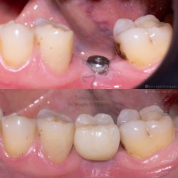 implant1