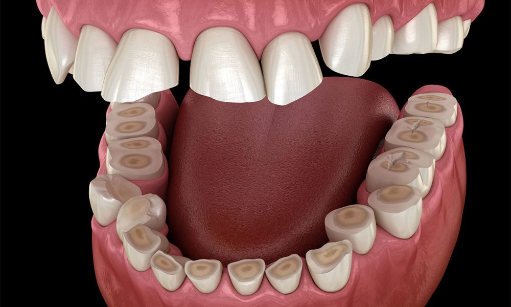 teeth-grinding-treatment-libertyville-il