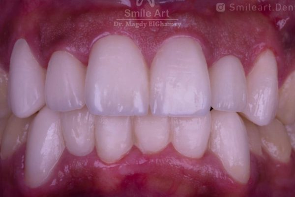 veneer.jpeg1.jpeg2